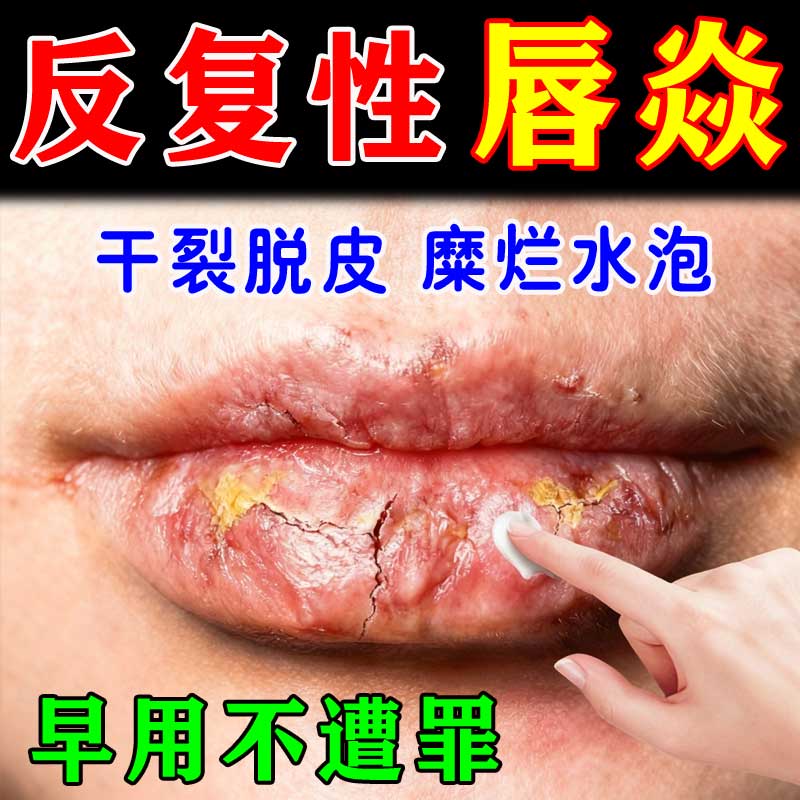 儿童可用唇炎唇膏嘴唇干裂脱皮专用唇愈宁修护口角炎烂嘴角润唇膏