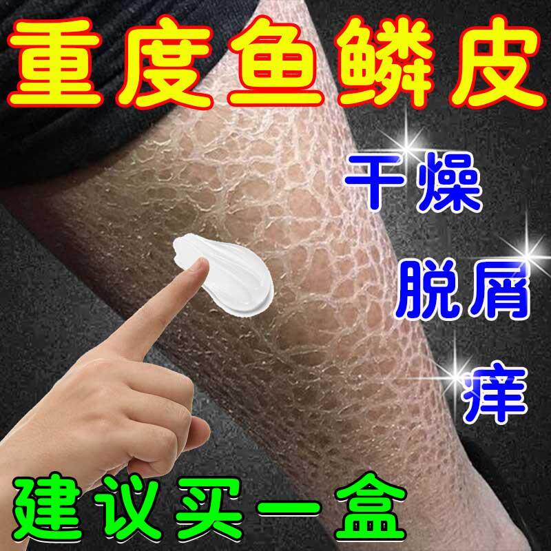 鱼鳞病皮肤霜专用膏保湿身体乳