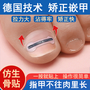 德国正甲贴片钛合金弹甲沟嵌矫正器脚趾甲盖内嵌神器专用指甲长肉