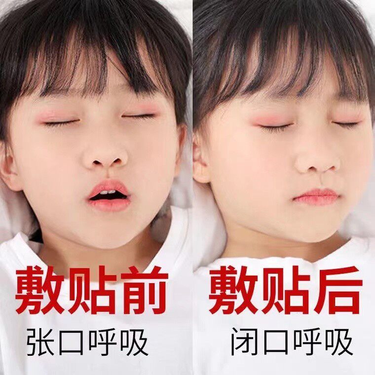 新腺样体肥大儿童宝宝面容矫正器鼻塞张嘴呼吸不通气嘴凸中药贴厂