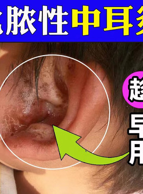 治疗耳朵流脓滴耳液进口成人用儿童外耳道中耳炎急慢性泰利必妥