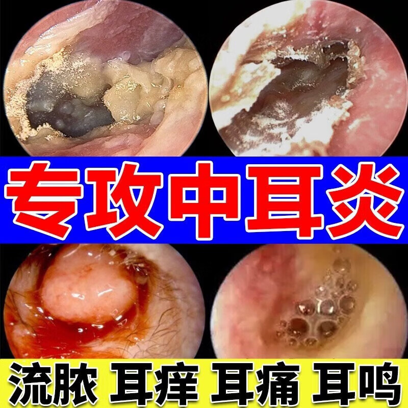 耳朵嗡嗡响滴耳液秒止鸣耳鸣神经性贴耳康贴膏嗡专用药