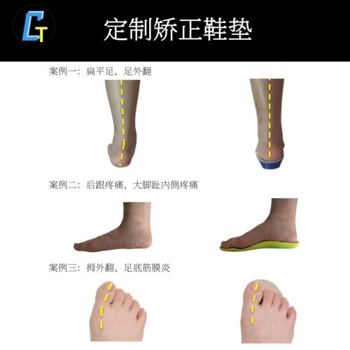 CGT定制矫形鞋垫医院同款TPU透气