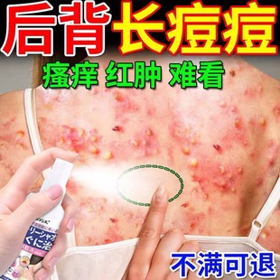 背粒消喷雾胸前胸后背祛痘痘背部背后背上长去除螨胸口水杨酸身体