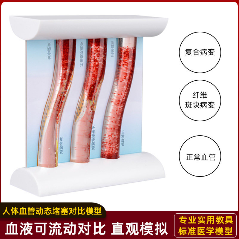 人体动态高血脂血管堵塞模型病变血液浓稠度流动演示对比医学教具