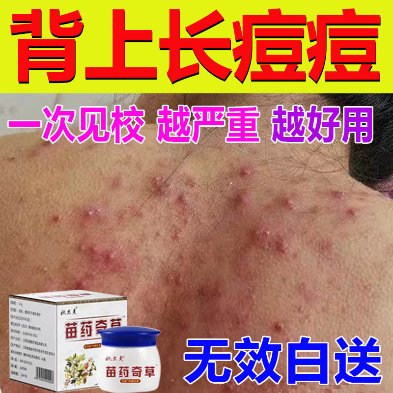 后背痘痘身体螨虫药膏
