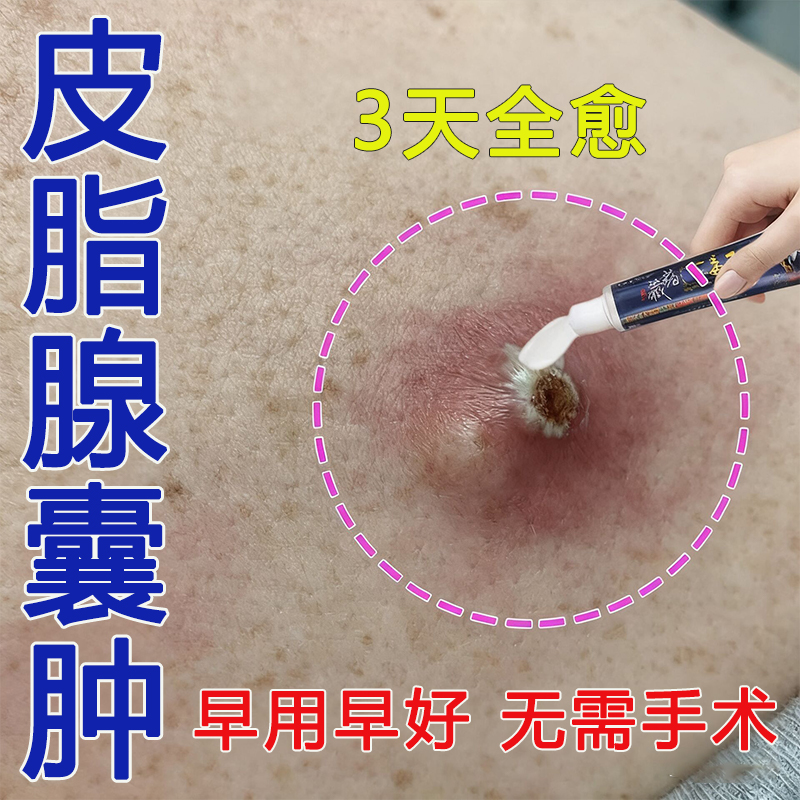 去除皮脂腺囊肿结节性痤疮硬块粉瘤脓包去皮下囊肿火疖子拔脓药膏