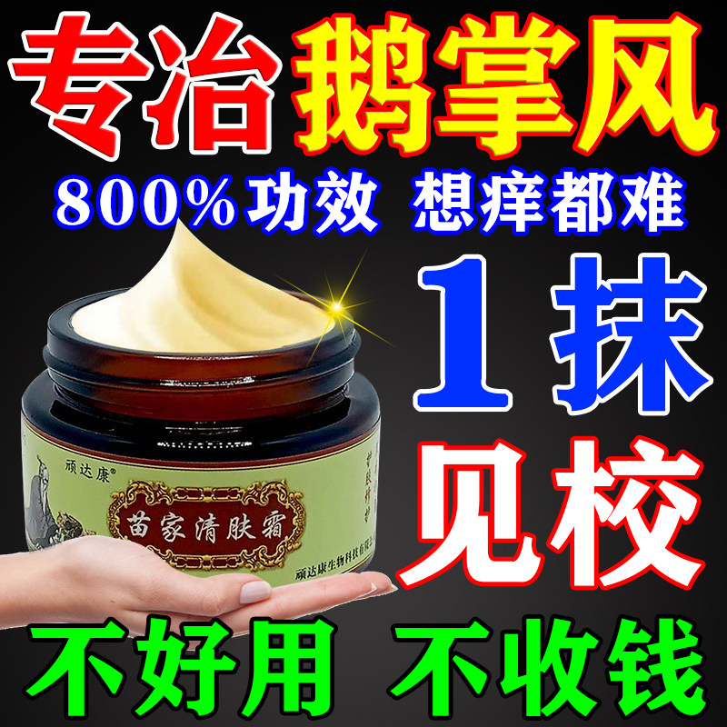 鹅掌风专用手藓膏药脱皮干裂真菌感染止痒抑菌专治鹅掌风特效膏药
