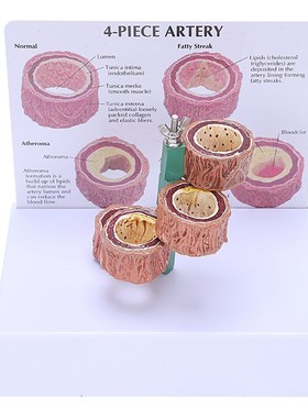 Atherosclerosis Thrombosis Model Vascular Disease Demonstrat