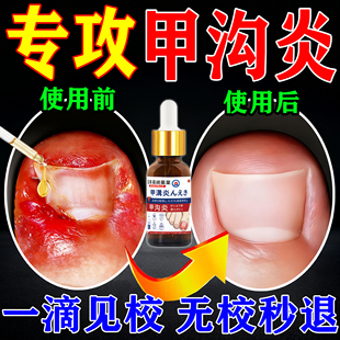 甲沟炎治疗专用特效膏药去肉芽脚趾甲往肉里长除息肉嵌甲软化剂
