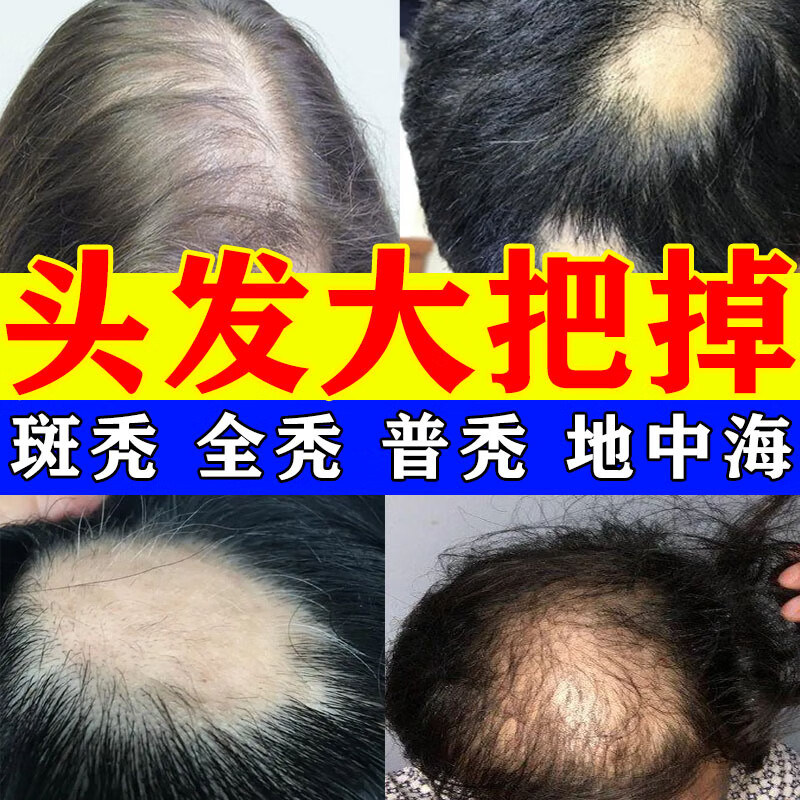 胱氨酸片生发yb产后继发脱发症治疗区别于防脱发药生发防脱发药