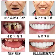 牙套吃饭神器老人假牙套仿真通用缺牙临时牙套遮盖门牙齿矫正美白