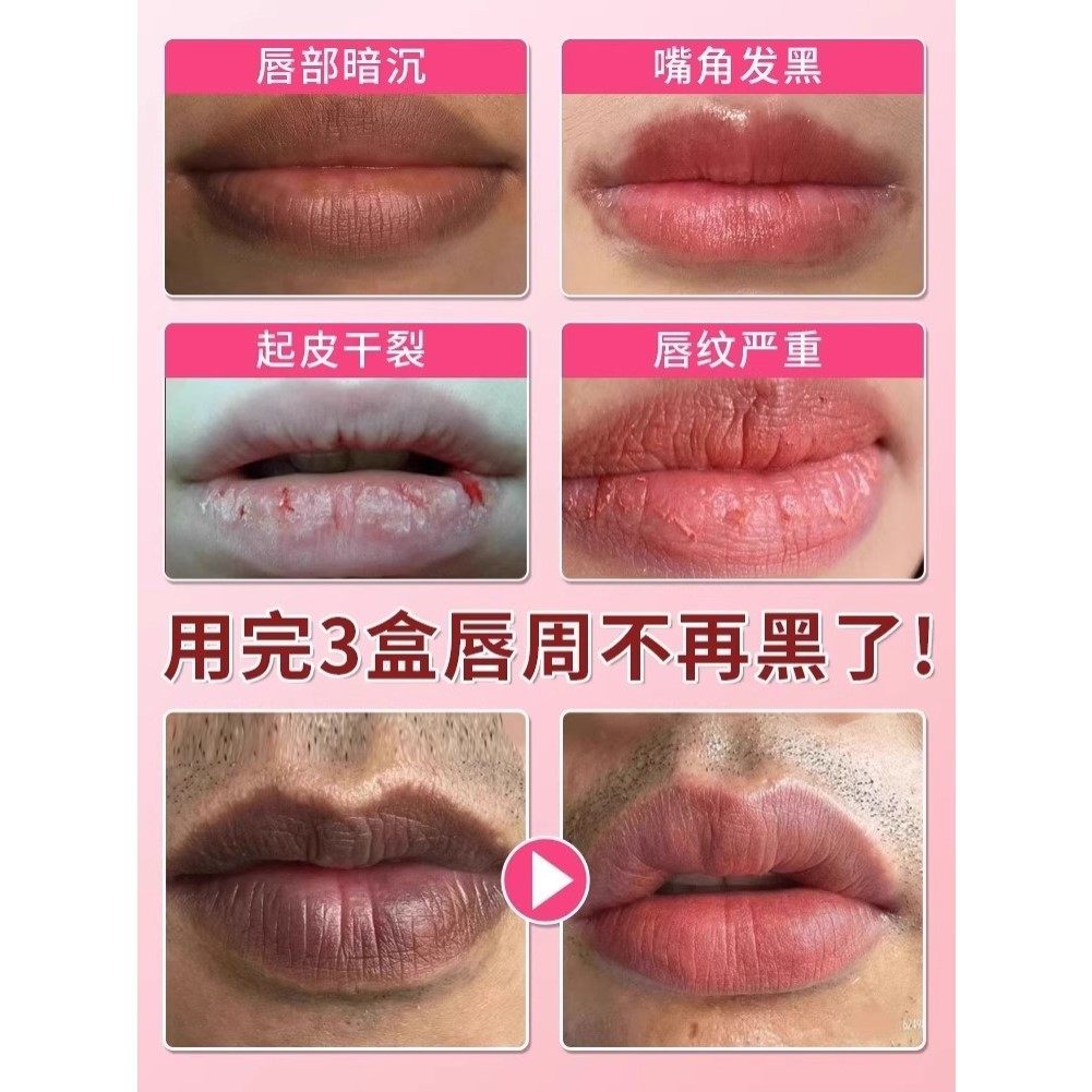 嘴唇发黑发紫去除嘴巴周边暗沉黑色素改善专用膏修复淡化唇部色纹