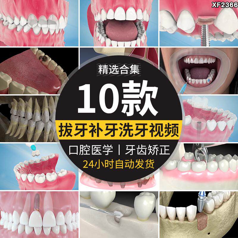 拔牙补牙洗牙口腔镶牙龈假牙种植牙齿矫正清洗3D动画演示视频素材
