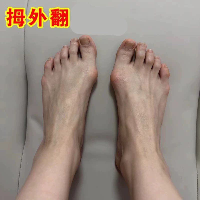 【已冶愈10万人】拇外翻贴脚趾重叠防磨大脚骨外翻矫正专用膏药