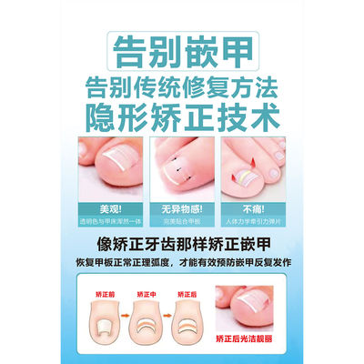 嵌甲贴片广告贴纸海报会灰指甲店背景墙甲沟炎手脚常见病图谱矫正