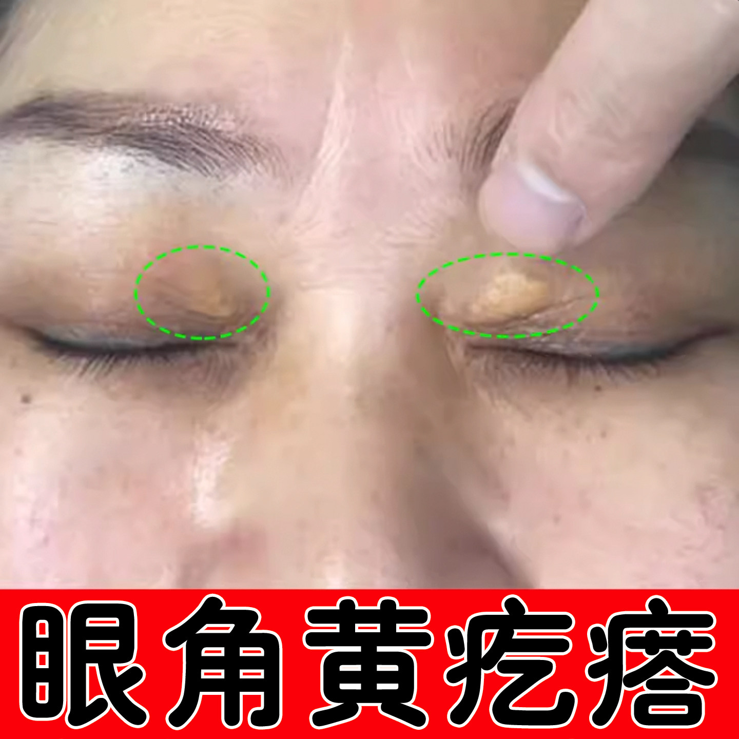 眼睑黄//疙瘩去眼皮黄斑//留专用膏去黄色肉块疙瘩脂肪粒色斑凸起