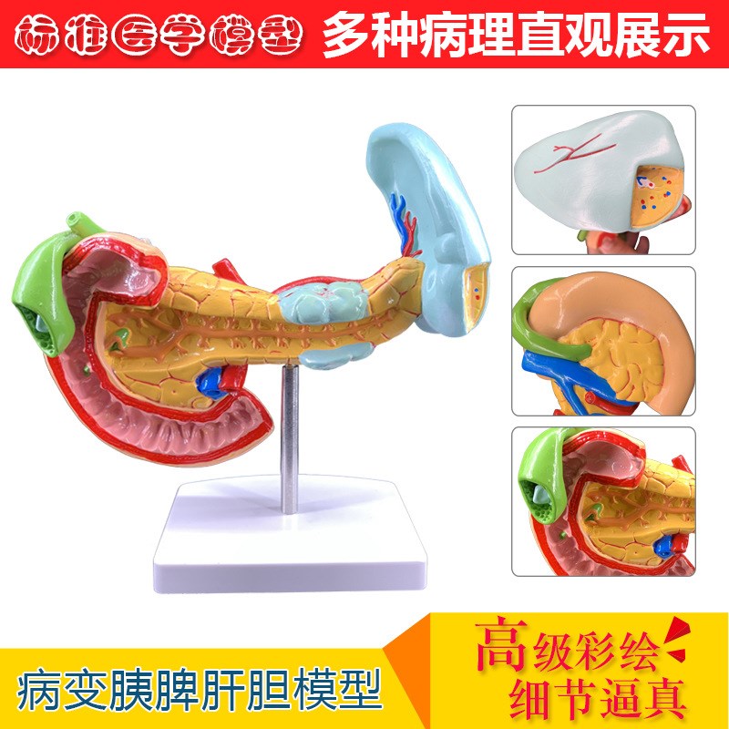 速发学教病变胰脾肝胆本二指肠模型病理胰腺标十胰脾肝胆解剖