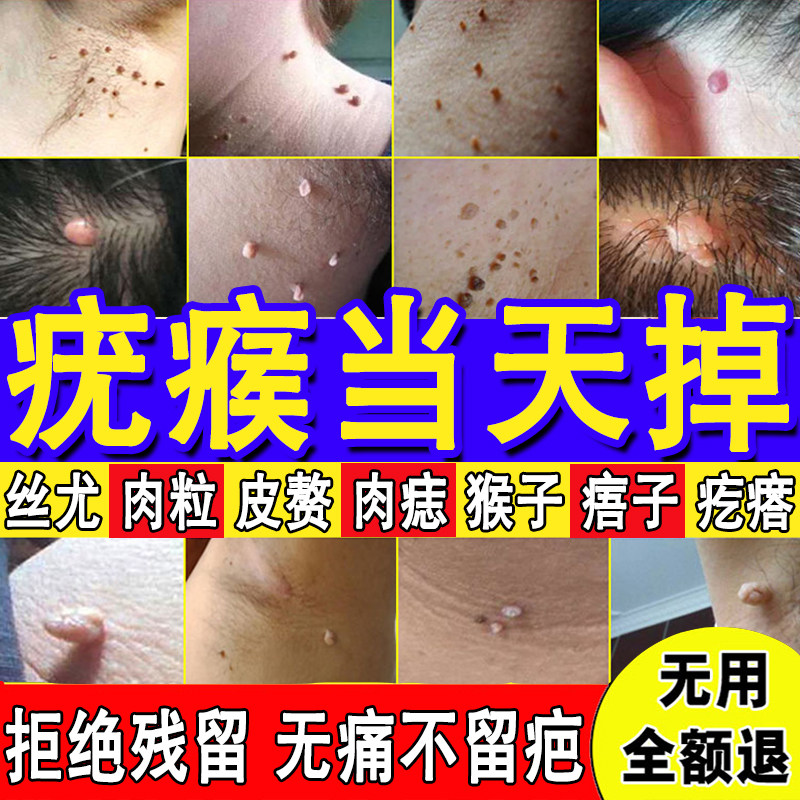 祛脖子上小肉粒扁平--超管用
