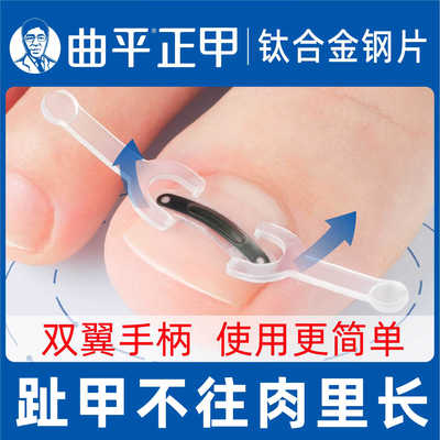 曲平医生甲沟嵌甲矫正器钛合金