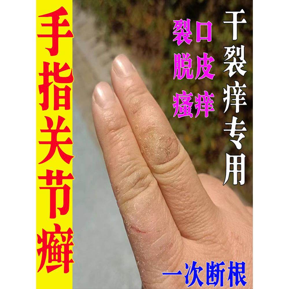 手指关节癣真菌手指关节长硬疙瘩伤癣脱皮干裂手癣真菌感染硬块