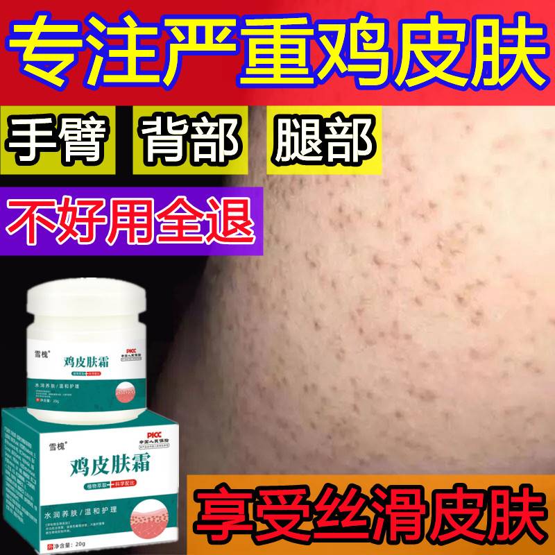鸡皮肤疙瘩毛囊角化药膏消除脸部腿上胳膊的小疙瘩毛周角化症外用