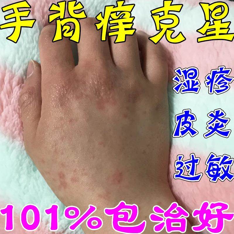 手背上长小豆豆疙瘩皮肤红肿痒紫外线过敏晒伤过敏起红点点抑菌药