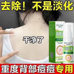 身体祛痘专用喷雾祛痘印去前胸脖子背部粉刺除螨背上长痘美背正品