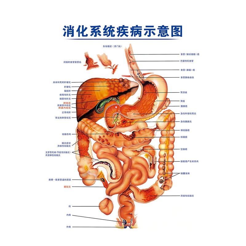 消化系统疾病示意图大肠肌肉与黏膜海报贴纸医院诊所墙贴纸kt板