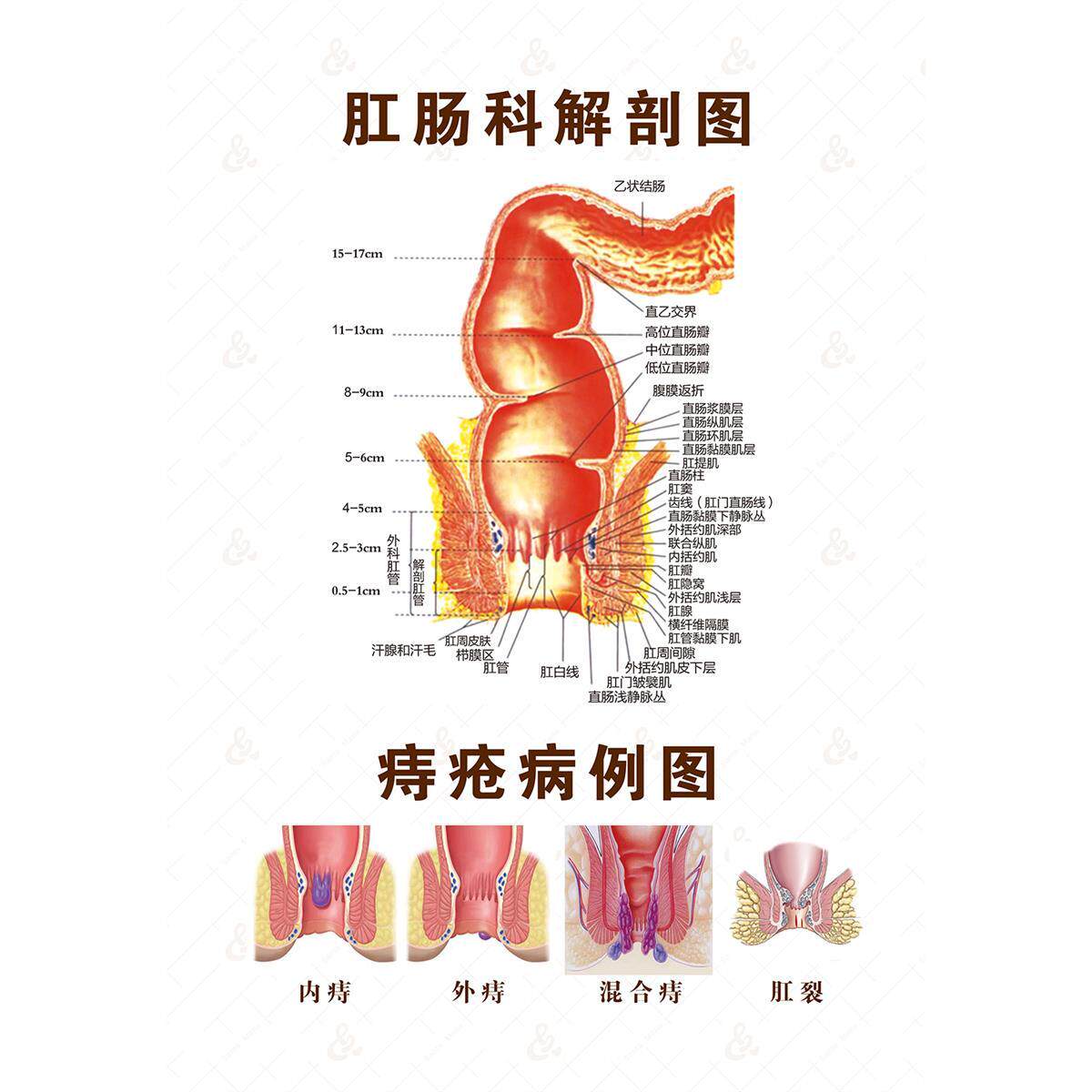 痔疮肛肠科肛门直肠解剖图宣传海报人体器官解剖图医院疾病挂图