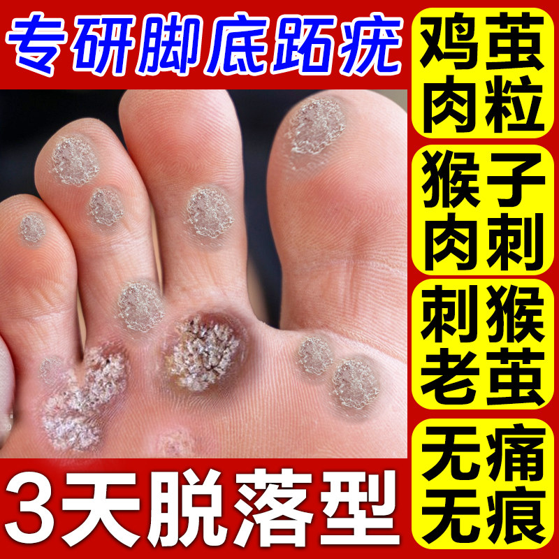 跖疣药膏疣瘊肉粒一抹无忧脚上长寻常疣拓趾病毒脚底足部清疣灵