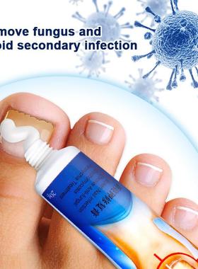 20g Nail Fungus Removal Cream Nail Care Ointment Anti-infect