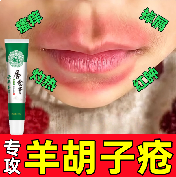 【小孩嘴周红】羊胡子疮儿童成人嘴周红肿上火烂嘴舔嘴唇周炎软膏