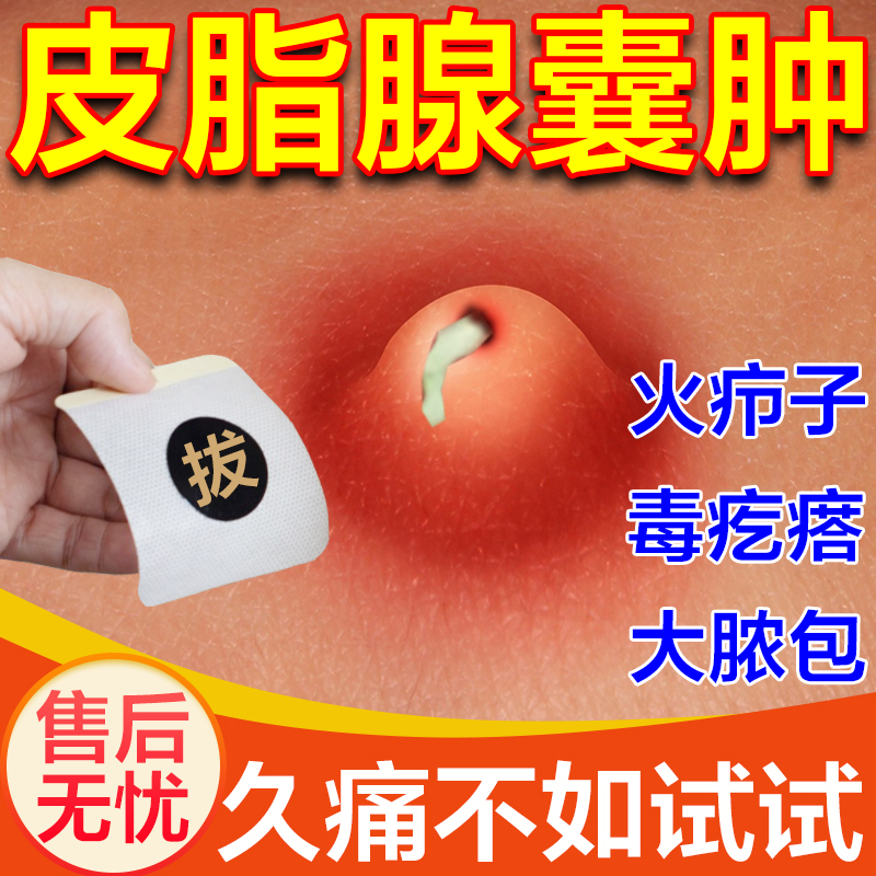 疖肿拔毒膏粉瘤皮脂腺囊肿屁股上长痘火疖子坐疮去皮下鼓包脓包贴