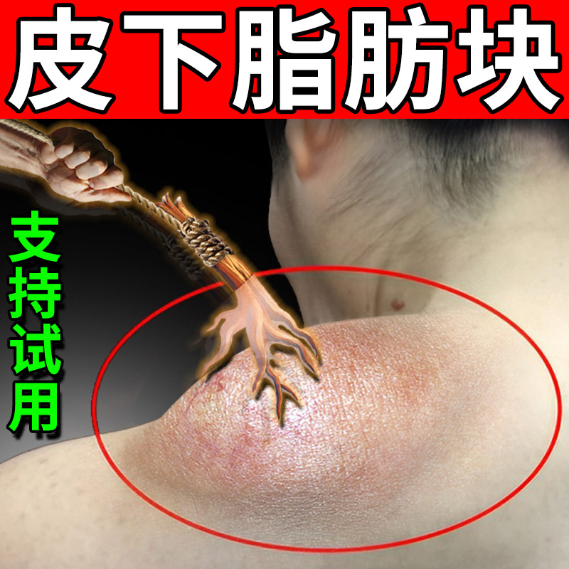 脂肪瘤药膏肿硬块去除特药效皮肤纤维瘤多发性皮脂腺囊肿粉消瘤膏