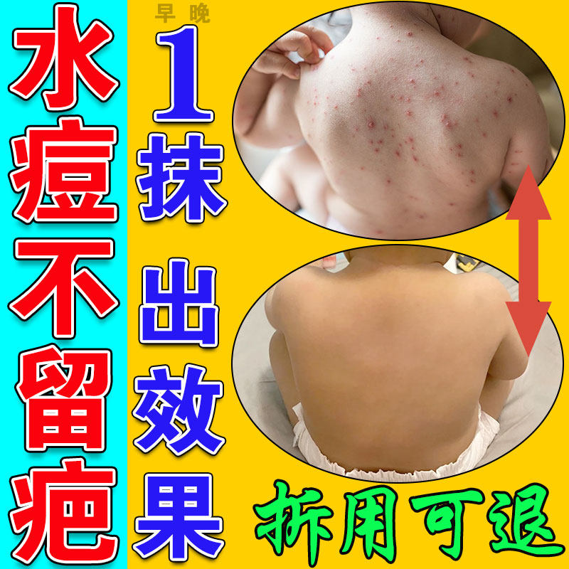 水痘疤痕修复祛疤膏除疤去痘印黑色素沉淀增生凹陷性儿童成人淡化