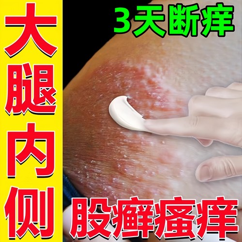 【大腿内侧股藓皮肤瘙痒乳膏！】