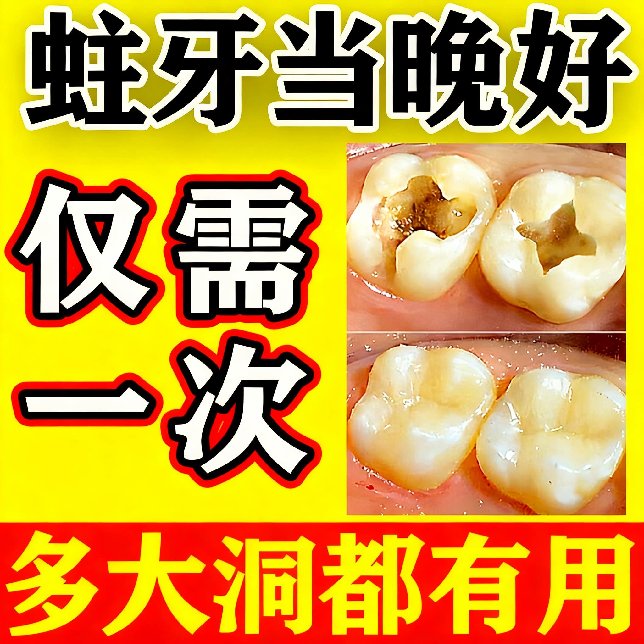 蛀牙牙洞牙虫清理的药粉龋齿修复洞牙自己补烂牙虫牙神器专用牙膏