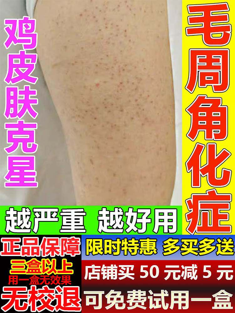 去鸡皮肤疙瘩毛囊角化药膏儿童脸部腿上胳膊上小疙瘩毛囊炎身体乳