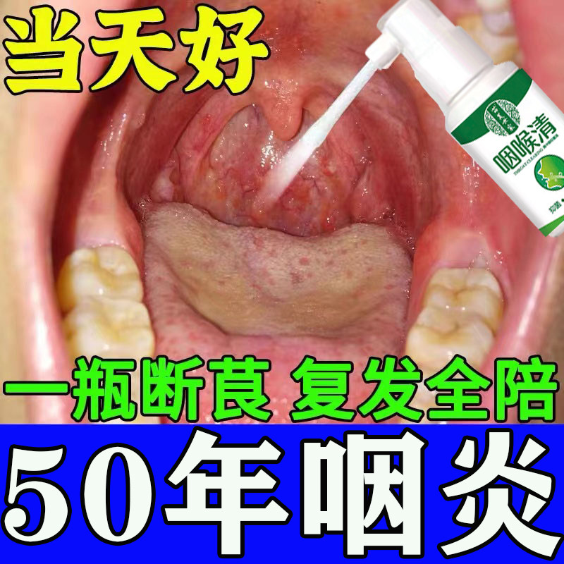 咽炎喷雾日本嗓子老有痰异物感治过敏性儿童慢性滤泡增生除根中药