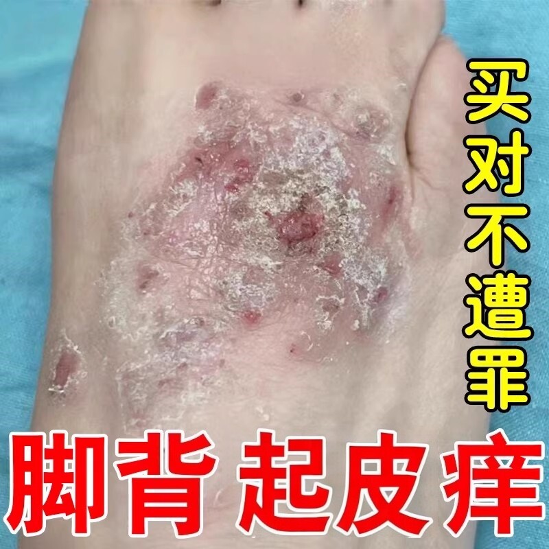 治疗脚背干燥痒脚面上干痒小疙瘩小水泡脱皮屑起皮皮肤痒专用的药