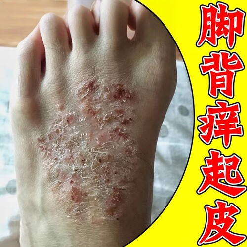 夏天脚背痒脚背干痒起水泡脚面起皮红点红疙瘩痒的挠破皮外用乳膏