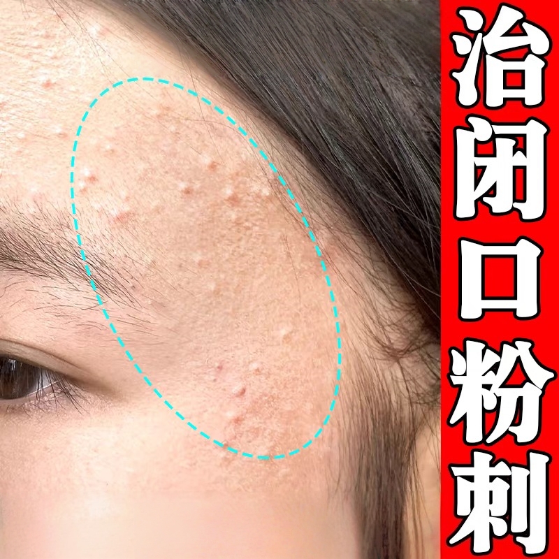 去额头闭口粉刺痘痘脸上长痘起小疙瘩逆光疹小颗粒去豆豆淡痘印膏