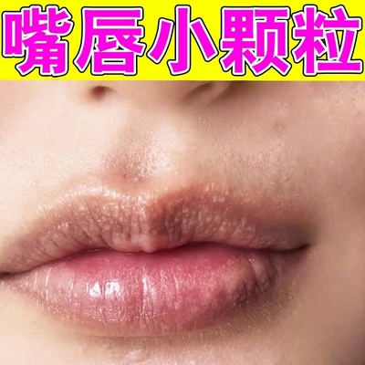 皮脂腺异位症嘴唇白点脂肪小颗粒皮脂腺增生嘴巴泡疹外用修护唇膏