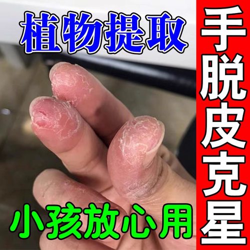 专治小孩手脱皮真菌脱皮治疗干燥干裂起皮掉皮消炎止痒专用特效药