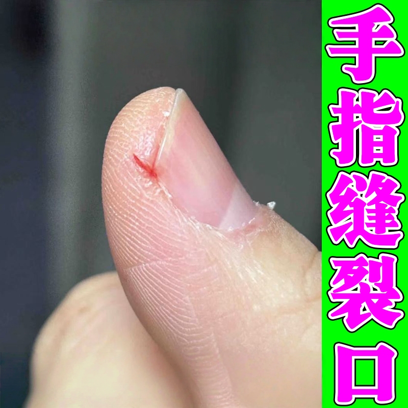 手指头开裂脱皮皲裂愈合膏