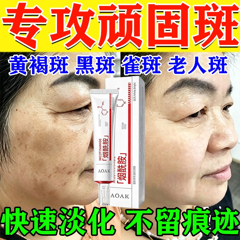 老年斑去除神器黑色素淡班霜雀斑强力去除手部脸部黄褐斑身体乳膏