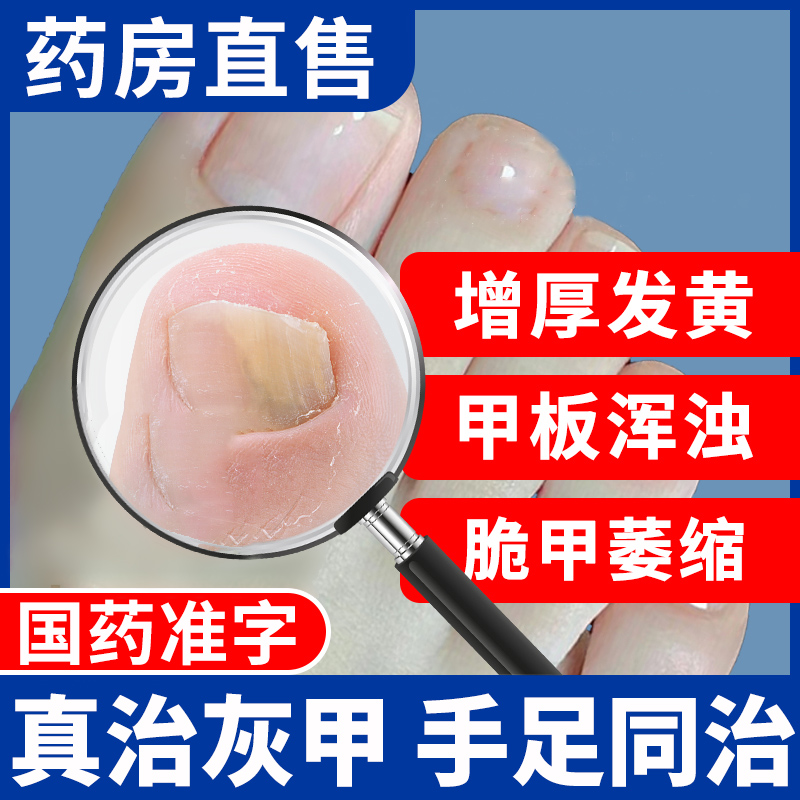 治疗灰指甲专用药膏抑菌液甲沟炎去灰甲药水正品旗舰店非特效6BF