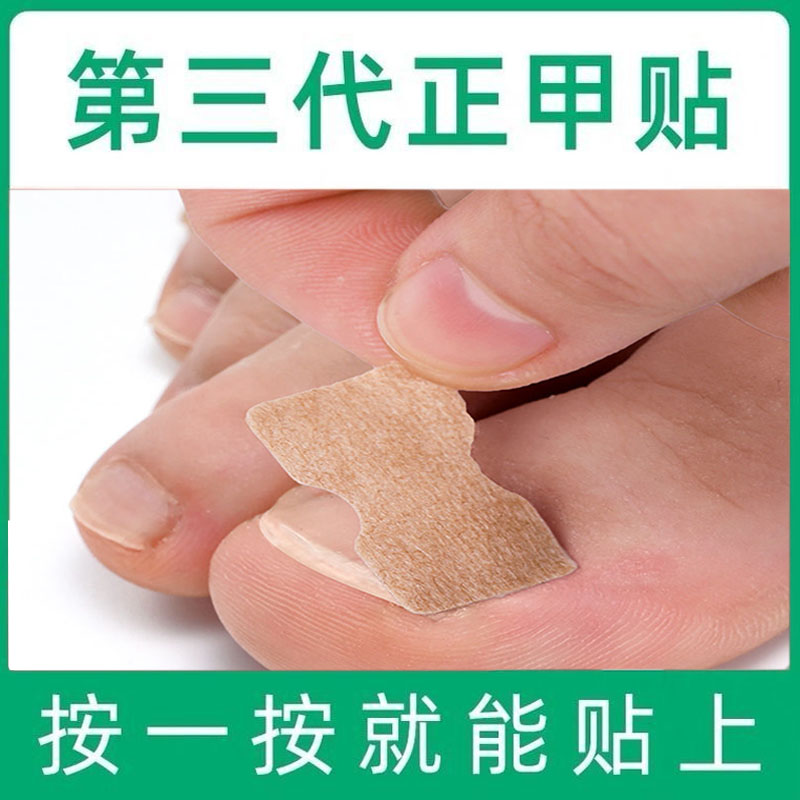 正甲贴甲沟垫片嵌甲专用矫正器