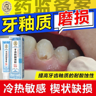 牙釉质磨损可搭牙齿酸痛牙膏修复楔状缺损补锲牙龈萎缩冷热敏感wg